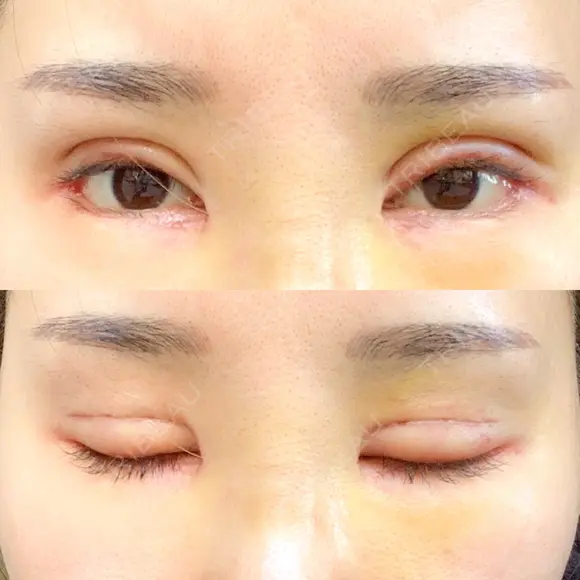 二重切開 / 目頭切開 / その他（目元） / 目尻切開 / タレ目形成・グラマラスライン（切開） id（アイディ）美容外科 DAY 11 メイン用