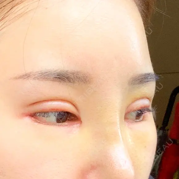 二重切開 / 目頭切開 / その他（目元） / 目尻切開 / タレ目形成・グラマラスライン（切開） id（アイディ）美容外科 DAY 11 メイン用
