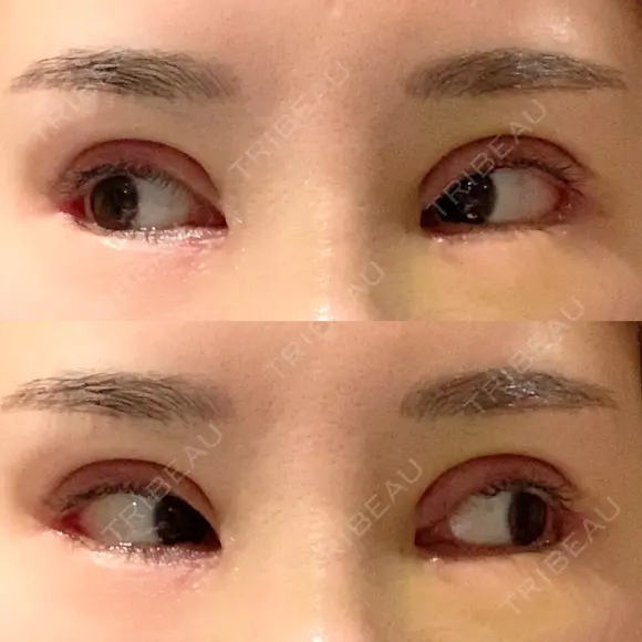 二重切開 / 目頭切開 / その他（目元） / 目尻切開 / タレ目形成・グラマラスライン（切開） id（アイディ）美容外科 DAY 12 メイン用