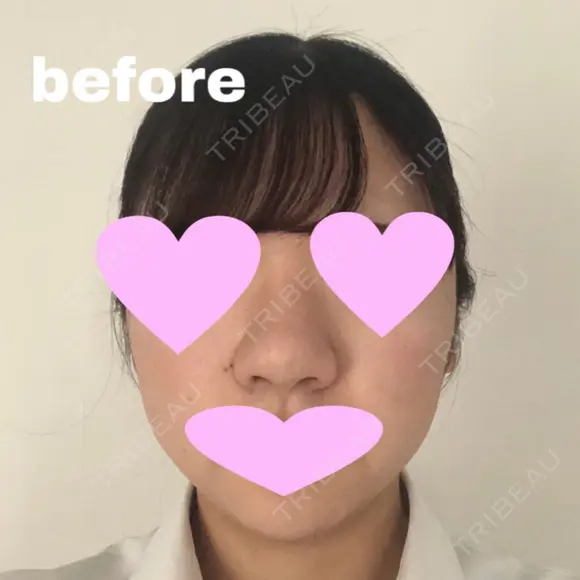 鼻中隔延長（切開） / 小鼻縮小（切開） / 軟骨移植 / 鼻尖縮小 / 鼻孔縁下降 / その他（鼻） 加美（GAMI）整形外科 DAY 24 メイン用