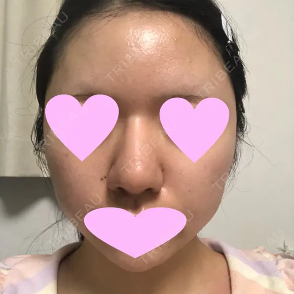 鼻中隔延長（切開） / 小鼻縮小（切開） / 軟骨移植 / 鼻尖縮小 / 鼻孔縁下降 / その他（鼻） 加美（GAMI）整形外科 DAY 27 メイン用