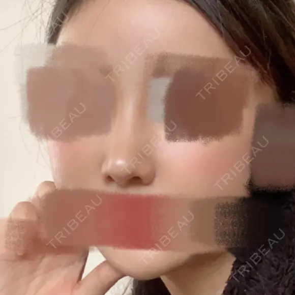 鼻尖形成（切開） / その他（鼻） / 軟骨移植 / 骨切幅寄せ / ワシ鼻修正・ハンプ切除 ソウルクイーン整形外科（旧コエンミ整形外科） DAY 150 メイン用