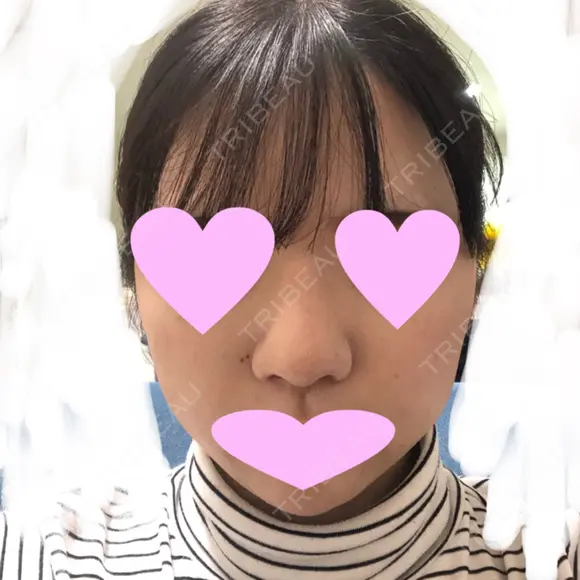 鼻中隔延長（切開） / 小鼻縮小（切開） / 軟骨移植 / 鼻尖縮小 / 鼻孔縁下降 / その他（鼻） 加美（GAMI）整形外科 DAY 28 メイン用