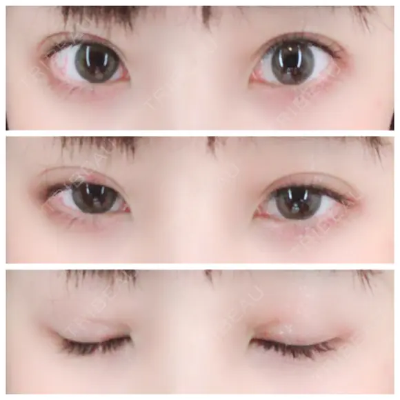 二重埋没 / 眼瞼下垂（切開） / クマ治療 / 下まぶたの脂肪取り THE MEDICAL SALON DAY 19 メイン用