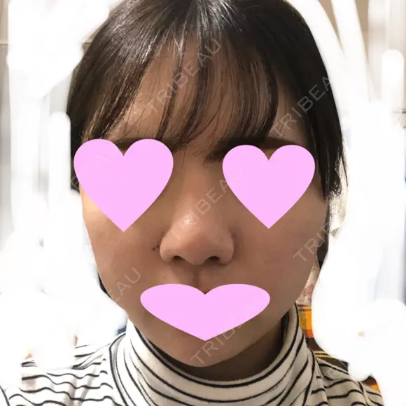 鼻中隔延長（切開） / 小鼻縮小（切開） / 軟骨移植 / 鼻尖縮小 / 鼻孔縁下降 / その他（鼻） 加美（GAMI）整形外科 DAY 29 メイン用