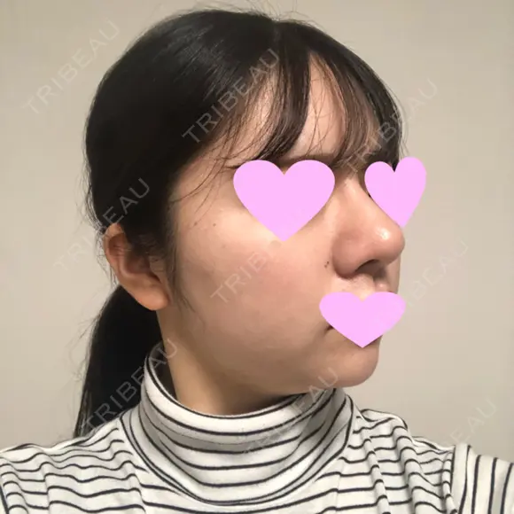 鼻中隔延長（切開） / 小鼻縮小（切開） / 軟骨移植 / 鼻尖縮小 / 鼻孔縁下降 / その他（鼻） 加美（GAMI）整形外科 DAY 29 メイン用