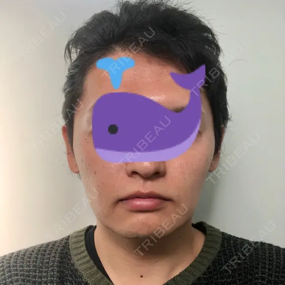 バッカルファット除去 / 脂肪吸引（顔） グロービー美容整形外科 DAY 26 メイン用