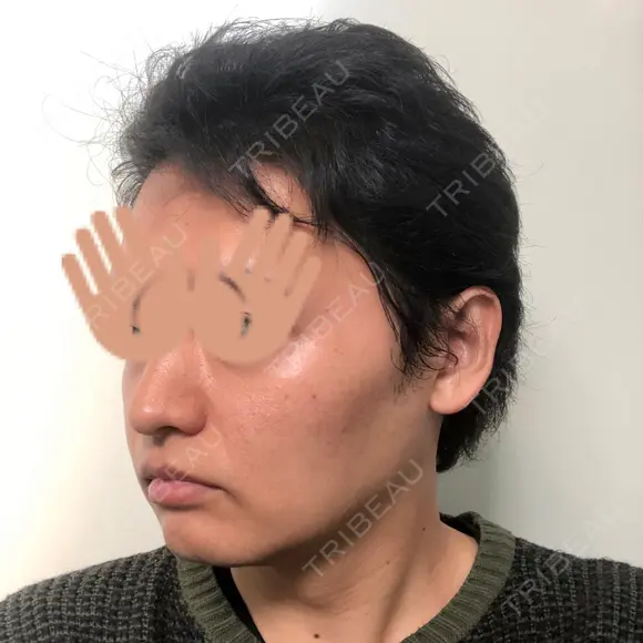 バッカルファット除去 / 脂肪吸引（顔） グロービー美容整形外科 DAY 26 メイン用