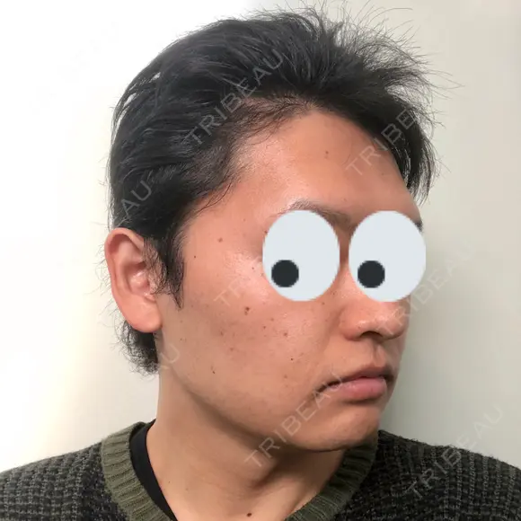 バッカルファット除去 / 脂肪吸引（顔） グロービー美容整形外科 DAY 26 メイン用