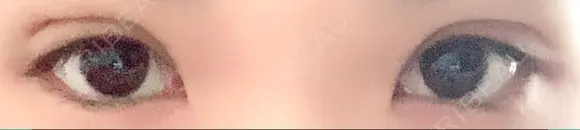 二重埋没 / 上まぶたの脂肪取り TCB東京中央美容外科 江坂院 DAY 10 メイン用