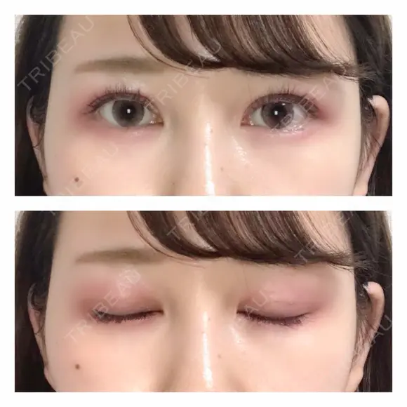 二重埋没 / バッカルファット除去 / 脂肪吸引（顔） / ヒアルロン酸注入（あご） / ボトックス（エラ・小顔） / 美容点滴・美容注射（美肌） エートップ美容整形外科 DAY 13 メイン用