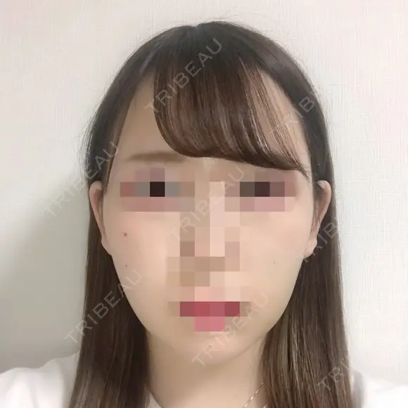 二重埋没 / バッカルファット除去 / 脂肪吸引（顔） / ヒアルロン酸注入（あご） / ボトックス（エラ・小顔） / 美容点滴・美容注射（美肌） エートップ美容整形外科 DAY 14 メイン用