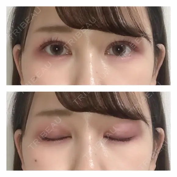 二重埋没 / バッカルファット除去 / 脂肪吸引（顔） / ヒアルロン酸注入（あご） / ボトックス（エラ・小顔） / 美容点滴・美容注射（美肌） エートップ美容整形外科 DAY 14 メイン用