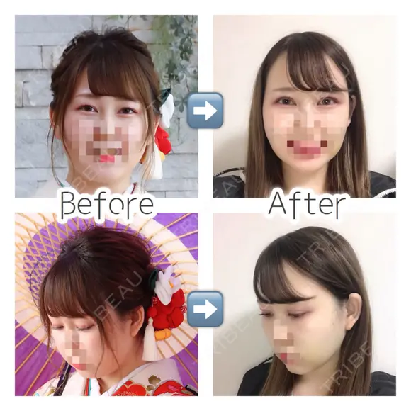 二重埋没 / バッカルファット除去 / 脂肪吸引（顔） / ヒアルロン酸注入（あご） / ボトックス（エラ・小顔） / 美容点滴・美容注射（美肌） エートップ美容整形外科 DAY 14 メイン用