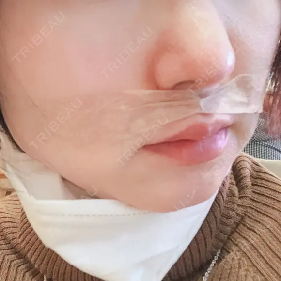 小鼻縮小（切開） / 鼻尖縮小 表参道スキンクリニック 表参道院 DAY 60 メイン用