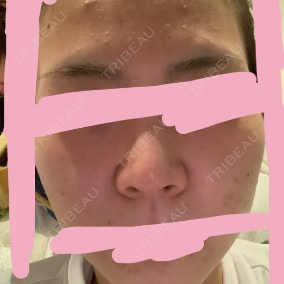 隆鼻術 / ヒアルロン酸注入（鼻） 東京ヒルズクリニック 新宿院 DAY 3 メイン用