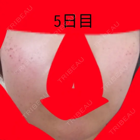 美肌レーザー / シミ取りレーザー / ルビーレーザー 銀座お肌の診療所 DAY 5 メイン用