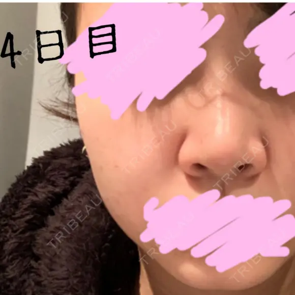 隆鼻術 / ヒアルロン酸注入（鼻） 東京ヒルズクリニック 新宿院 AFTER メイン用