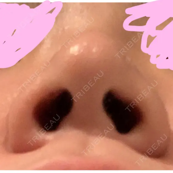 隆鼻術 / ヒアルロン酸注入（鼻） 東京ヒルズクリニック 新宿院 DAY 4 メイン用