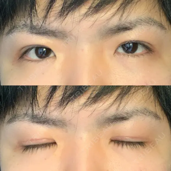 眼瞼下垂（切開） 札幌中央形成外科 DAY 30 メイン用