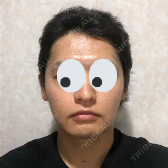 バッカルファット除去 / 脂肪吸引（顔） グロービー美容整形外科 DAY 34 メイン用