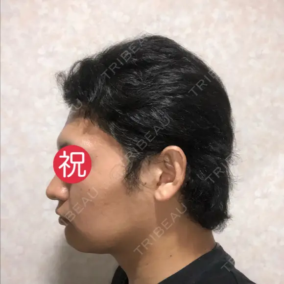 バッカルファット除去 / 脂肪吸引（顔） グロービー美容整形外科 DAY 34 メイン用