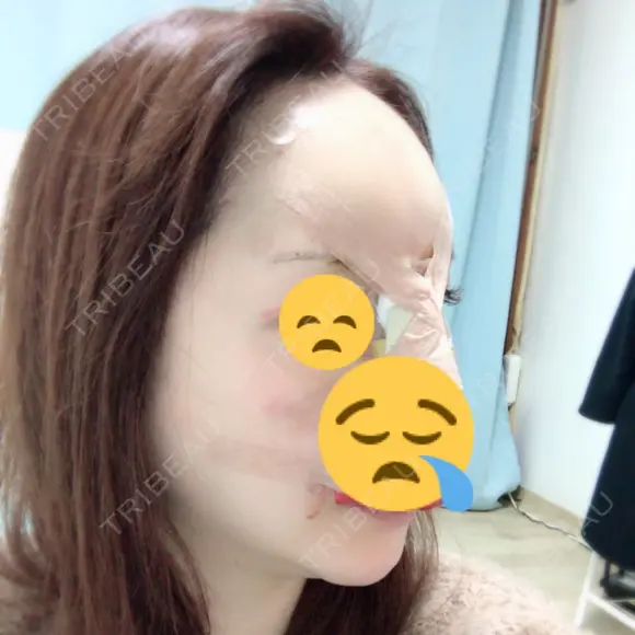 糸リフト / 骨切り（あご） / 骨削り（エラ） / 骨削り（頬） / 脂肪吸引（顔） / 輪郭修正 / 脂肪注入（額） / 脂肪注入（輪郭） / ハイフ（顔） GIRIN（ギリン）美容外科 DAY 58 メイン用