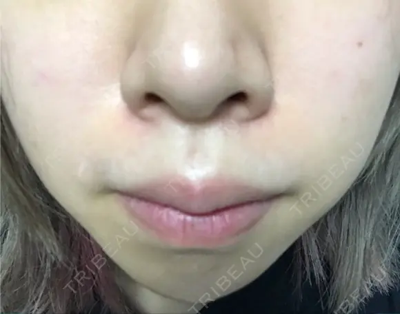 鼻尖形成（切開） / ヒアルロン酸注入（あご） TCB東京中央美容外科 世田谷院 AFTER メイン用
