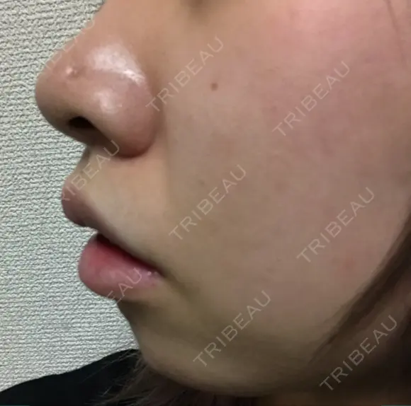 鼻尖形成（切開） / ヒアルロン酸注入（あご） TCB東京中央美容外科 世田谷院 DAY 26 メイン用