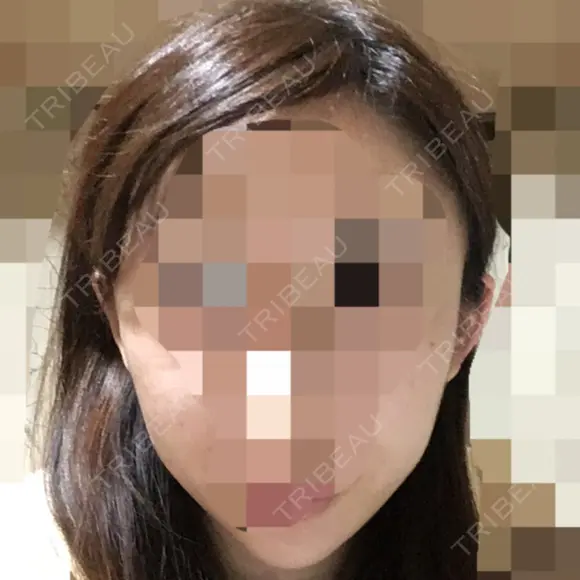 骨切り（あご） / 骨削り（エラ） / 骨削り（頬） ボンディ美容整形外科（旧リオン整形外科） DAY 82 メイン用