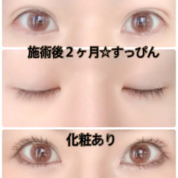 二重埋没 城本クリニック 姫路院 AFTER メイン用