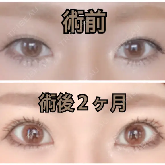 二重埋没 城本クリニック 姫路院 DAY 67 メイン用