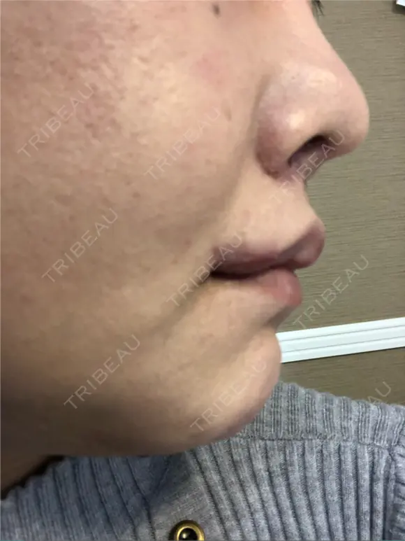 人中短縮 / 口角挙上 清潭女神美容外科 DAY 17 メイン用