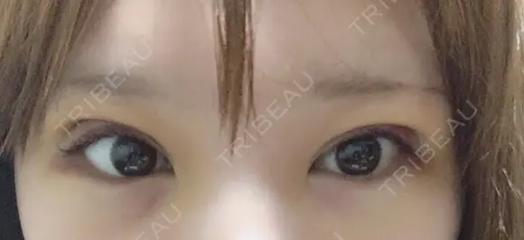 眼瞼下垂（切開） なでしこ皮膚科クリニック DAY 4 メイン用