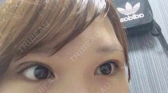 眼瞼下垂（切開） なでしこ皮膚科クリニック DAY 7 メイン用