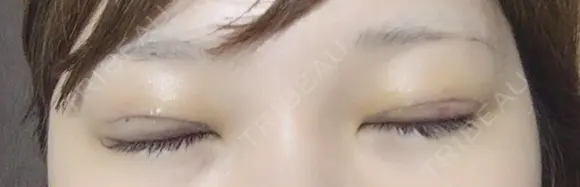 眼瞼下垂（切開） なでしこ皮膚科クリニック DAY 8 メイン用