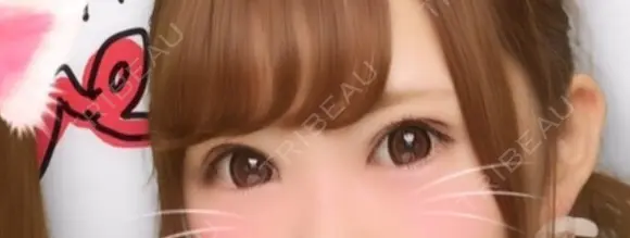 眼瞼下垂（切開） なでしこ皮膚科クリニック DAY 8 メイン用