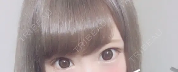 眼瞼下垂（切開） なでしこ皮膚科クリニック AFTER メイン用