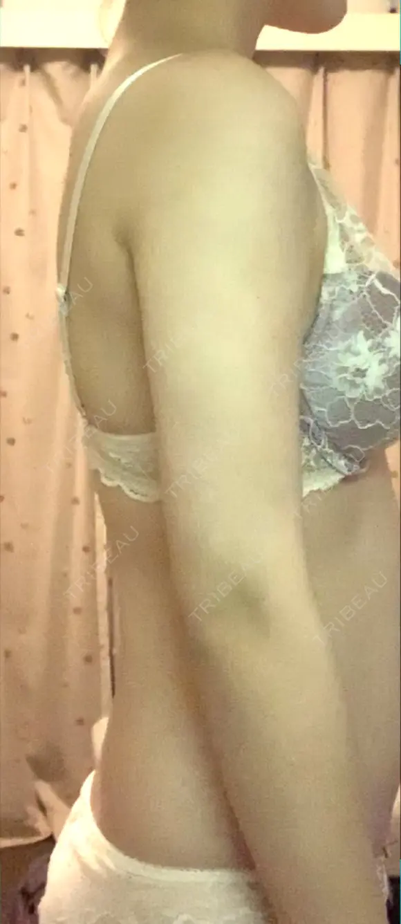 脂肪吸引（二の腕） プチパーティー医院 DAY 62 メイン用