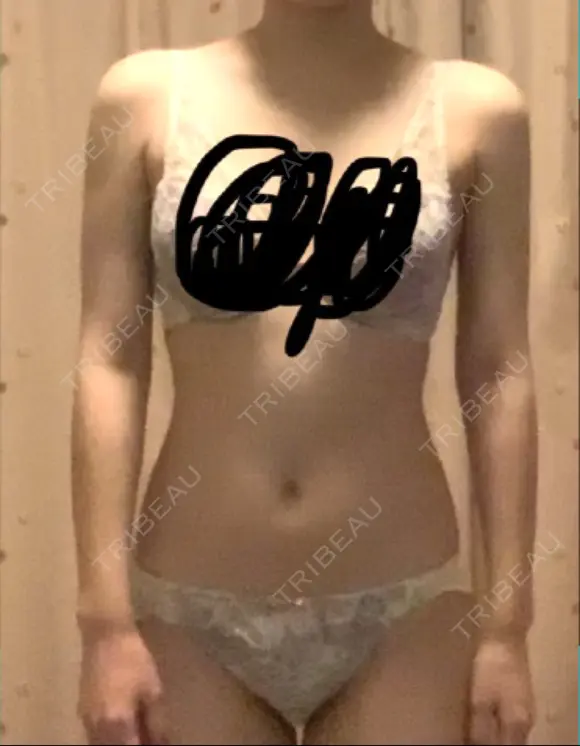 脂肪吸引（二の腕） プチパーティー医院 DAY 62 メイン用