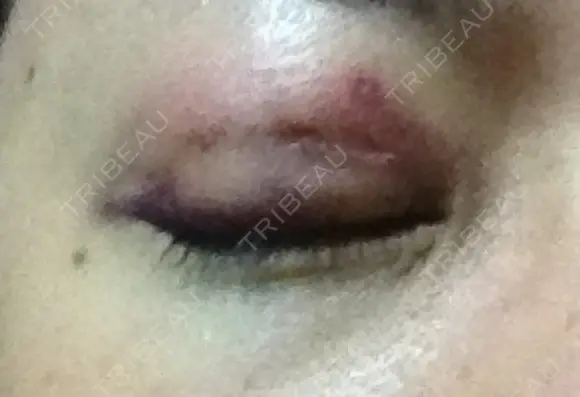 二重埋没 ライフクリニック DAY 2 メイン用