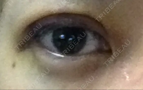 二重埋没 ライフクリニック DAY 4 メイン用