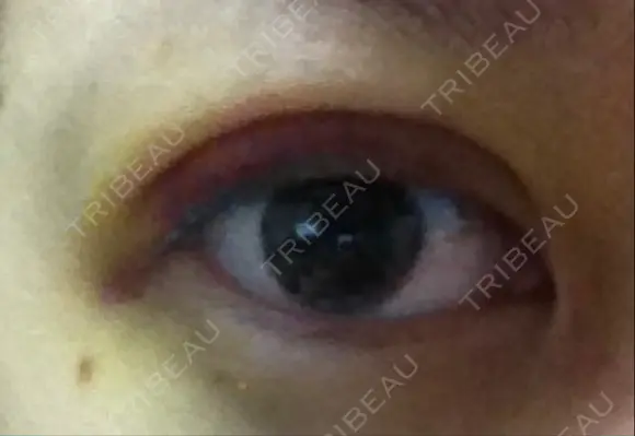 二重埋没 ライフクリニック DAY 6 メイン用