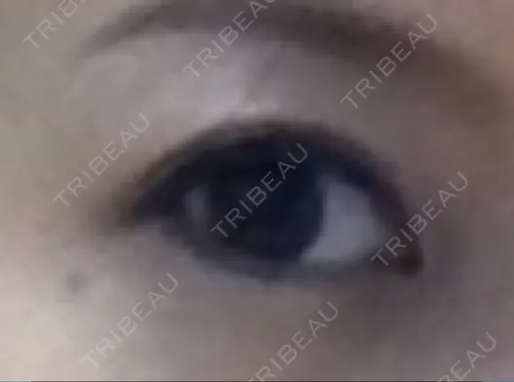 二重埋没 ライフクリニック DAY 64 メイン用