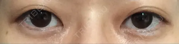 二重埋没 ライフクリニック DAY 399 メイン用