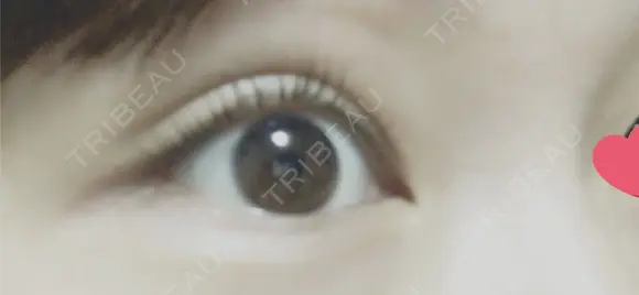 眼瞼下垂（切開） なでしこ皮膚科クリニック DAY 193 メイン用