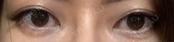 二重埋没 ライフクリニック DAY 2270 メイン用