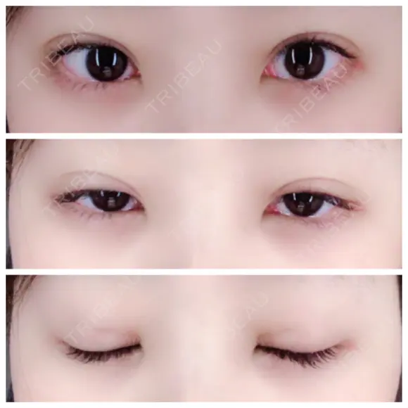 二重埋没 / 眼瞼下垂（切開） / クマ治療 / 下まぶたの脂肪取り THE MEDICAL SALON DAY 32 メイン用