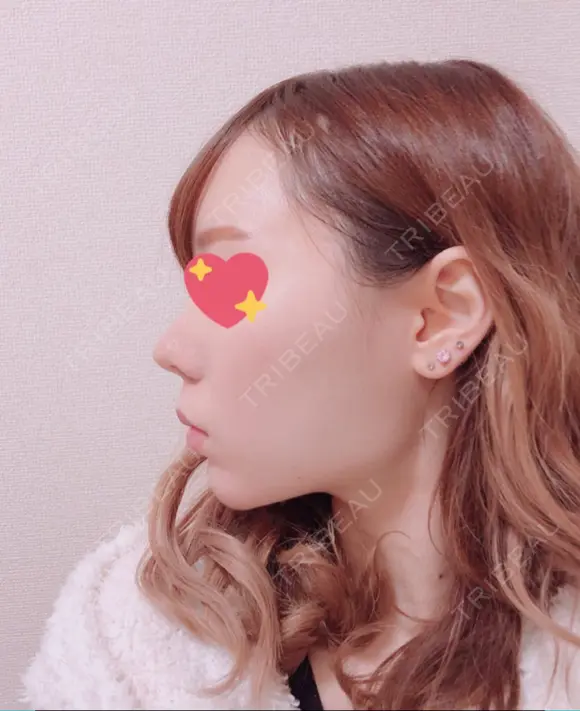 脂肪吸引（顔） / ボトックス（あご） / ボトックス（エラ・小顔） エートップ美容整形外科 AFTER メイン用