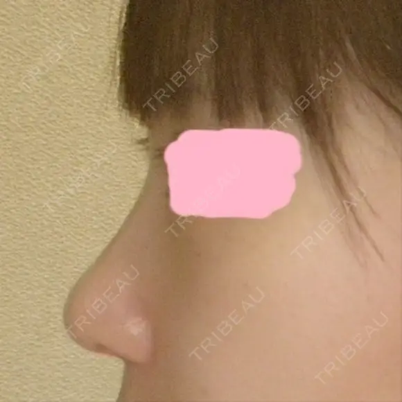 鼻尖形成（切開） / 小鼻縮小（切開） / 軟骨移植 / 骨切幅寄せ HANABI整形外科 DAY 80 メイン用